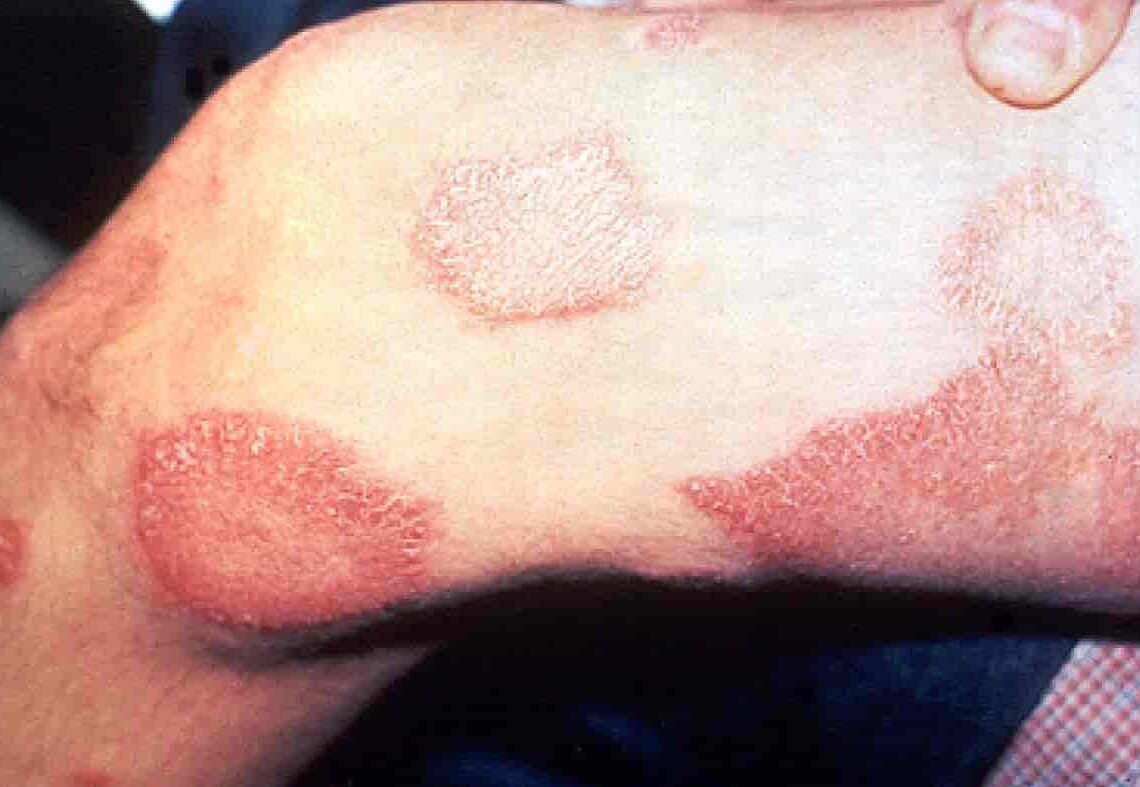 Leprosy Cases Inexplicably on the Rise in Florida, CDC Warns La Voce